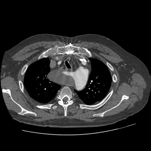 File:Aorto-coronary bypass graft aneurysms (Radiopaedia 40562-43157 A 28).png