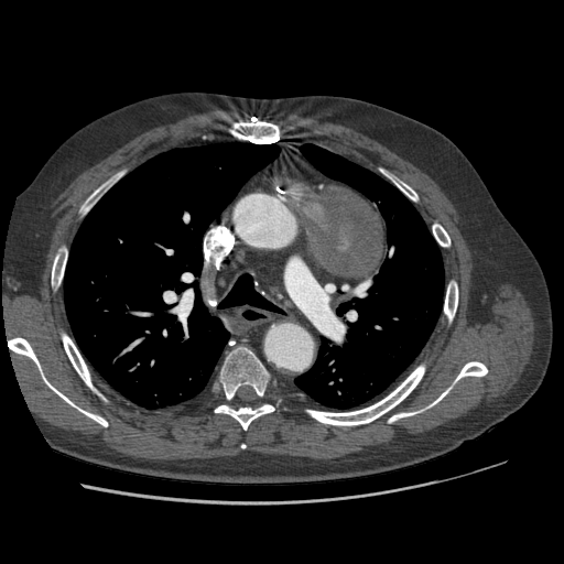 File:Aorto-coronary bypass graft aneurysms (Radiopaedia 40562-43157 A 43).png