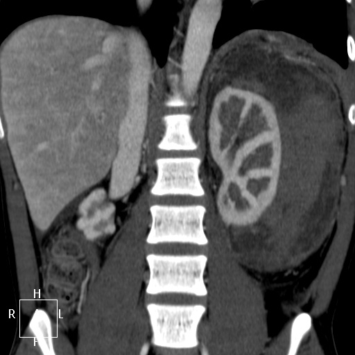 File:Aorto-left renal vein fistula (Radiopaedia 45534-49628 B 43).jpg