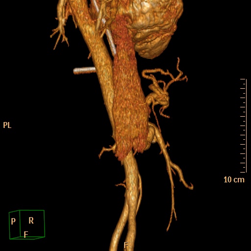 File:Aorto-left renal vein fistula (Radiopaedia 45534-49628 D 21).jpg