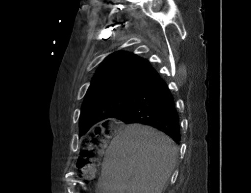Aortoesophageal fistula with endovascular repair (Radiopaedia 73781-84592 Sagittal C+ CTPA 28).jpg