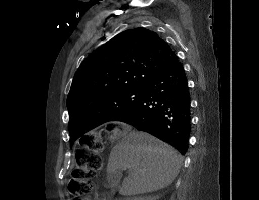 Aortoesophageal fistula with endovascular repair (Radiopaedia 73781-84592 Sagittal C+ CTPA 55).jpg