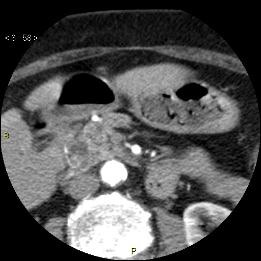 File:Aortoiliac occlusive disease (Radiopaedia 16828-16548 A 58).jpg