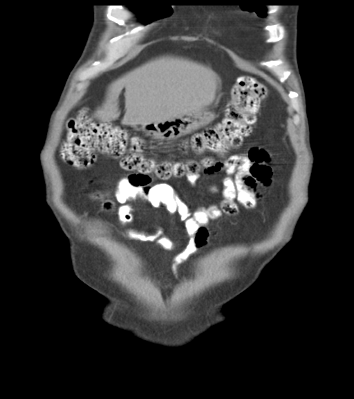 File:Appendiceal abscesses (Radiopaedia 50999-56542 Coronal non-contrast 14).png