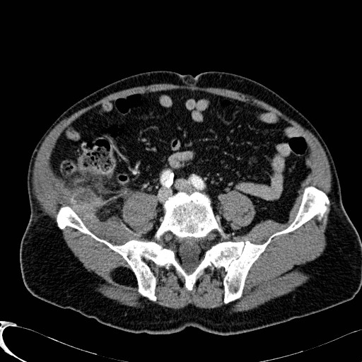 File:Appendiceal adenocarcinoma complicated by retroperitoneal abscess (Radiopaedia 58007-65039 B 95).jpg