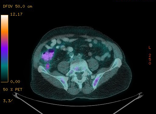 Appendiceal adenocarcinoma complicated by retroperitoneal abscess (Radiopaedia 58007-65041 Axial PET-CT 152).jpg