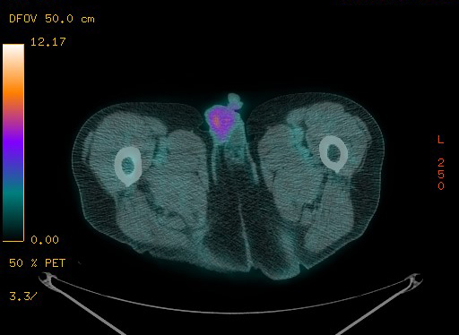 Appendiceal adenocarcinoma complicated by retroperitoneal abscess (Radiopaedia 58007-65041 Axial PET-CT 210).jpg