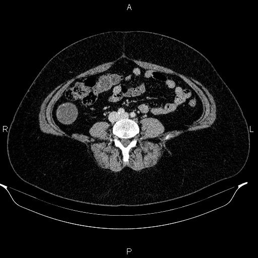 Appendiceal mucocele (Radiopaedia 83280-97688 Axial With contrast 66).jpg