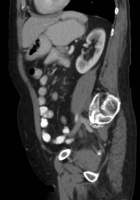 Appendicitis due to chicken fibula (Radiopaedia 74314-85198 C 68).jpg