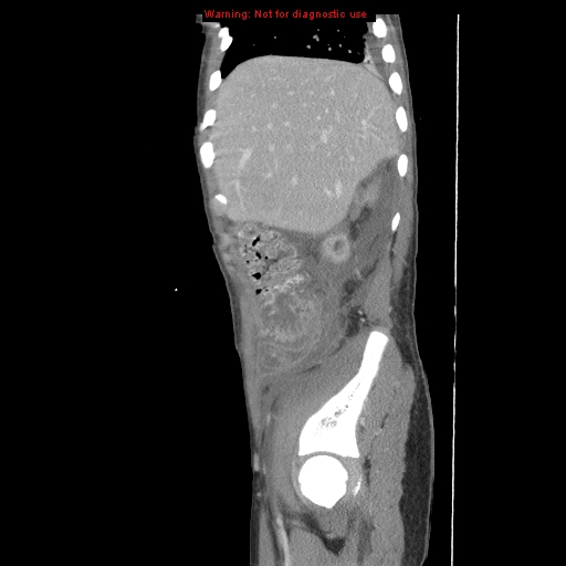 File:Appendicitis with phlegmon (Radiopaedia 9358-10046 F 7).jpg