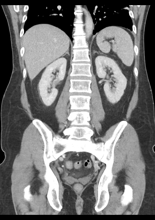 Appendicitis with thickening of the terminal ileum (Radiopaedia 42432-45550 B 40).png