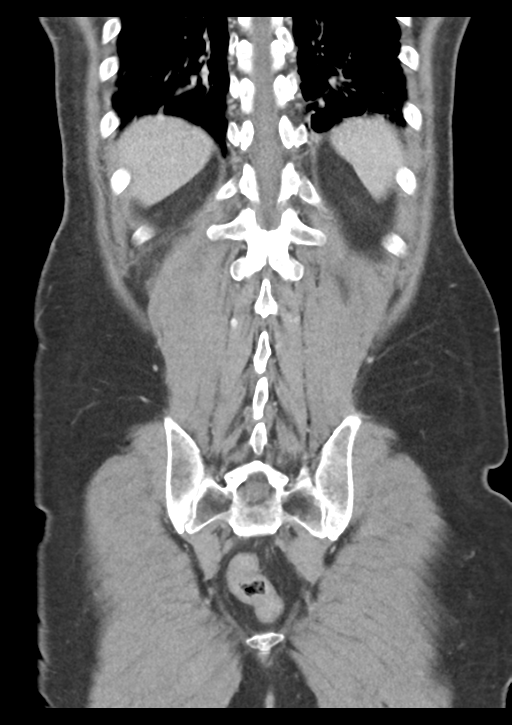 Appendicitis with thickening of the terminal ileum (Radiopaedia 42432-45550 B 48).png