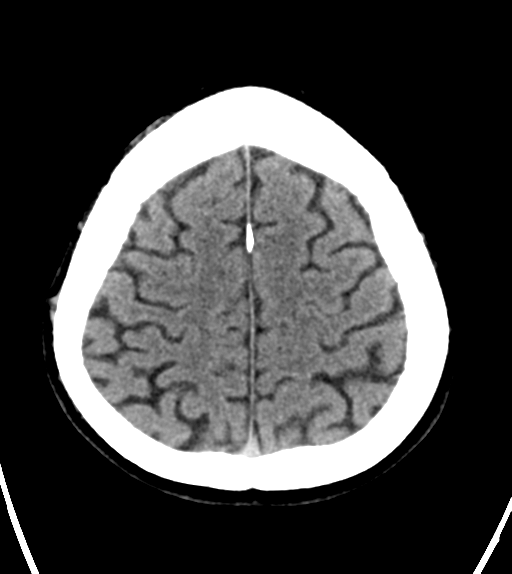 File:Aqueduct stenosis with corpus callosum hypoattenuation post shunting (Radiopaedia 37212-38971 Axial non-contrast 24).png