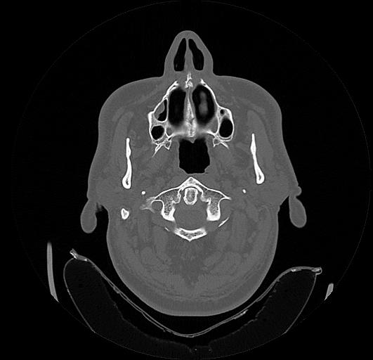 Arcuate foramen (Radiopaedia 89833-106944 Axial bone window 22).jpg