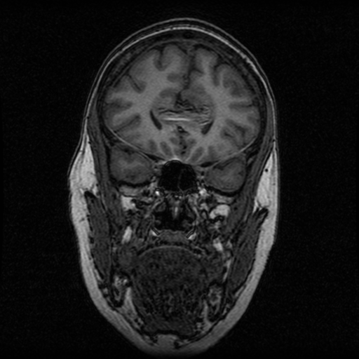 Arteriovenous malformation (cerebral) (Radiopaedia 40070-42580 Coronal T1 44).png