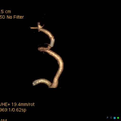 File:Artifactual basilar artery stenosis due to metallic stent (Radiopaedia 31206-31923 C 11).jpg