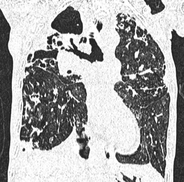 Aspergilloma- with Monod sign (Radiopaedia 44737-48532 Coronal lung window 241).jpg