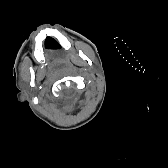 File:Atlanto-occipital dissociation (Traynelis type 1), C2 teardrop fracture, C6-7 facet joint dislocation (Radiopaedia 87655-104061 Axial non-contrast 11).jpg