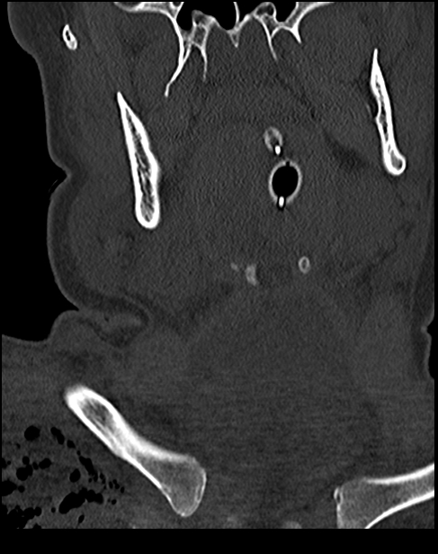 Atlanto-occipital dissociation - Traynelis type 1 (Radiopaedia 87570-103948 Coronal bone window 9).jpg