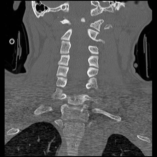 Atlanto-occipital dissociation injury (Radiopaedia 29274-29698 Coronal bone window 23).png