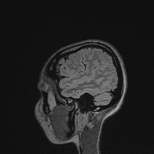 Atretic encephalocoele with inferior vermis hypoplasia (Radiopaedia 30443-31108 Sagittal FLAIR 129).jpg
