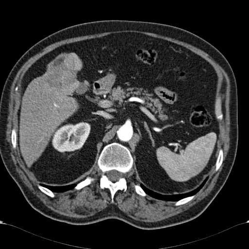 Atypical hepatocellular carcinoma (Radiopaedia 41744-44698 A 34).jpg