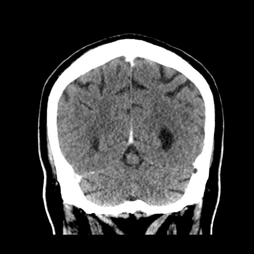 Atypical meningioma (WHO grade II) with brain invasion (Radiopaedia 57767-64728 Coronal C+ 48).png