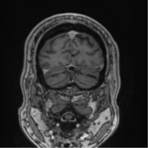 Atypical meningioma (WHO grade II) with brain invasion (Radiopaedia 57767-64729 Coronal T1 C+ 74).png