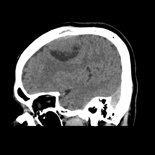 Atypical meningioma with skull invasion (Radiopaedia 34357-35649 E 15).png