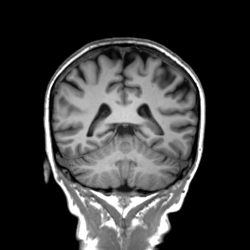 Autoimmune limbic encephalitis (Radiopaedia 30363-31005 Coronal T1 21).jpg