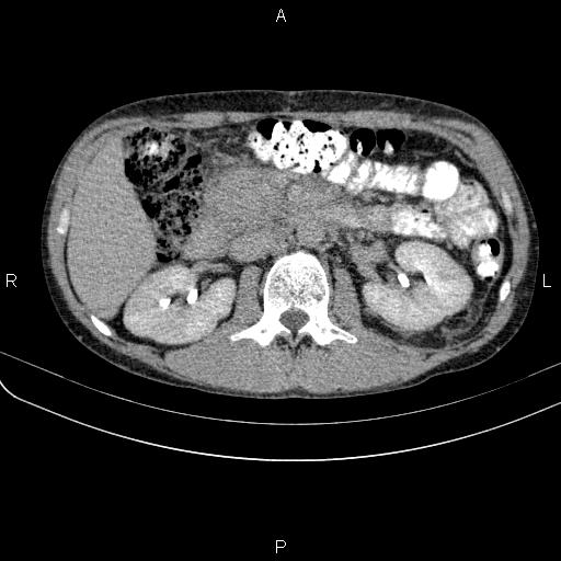 File:Autoimmune pancreatitis (Radiopaedia 84925-100431 Axial C+ delayed 31).jpg