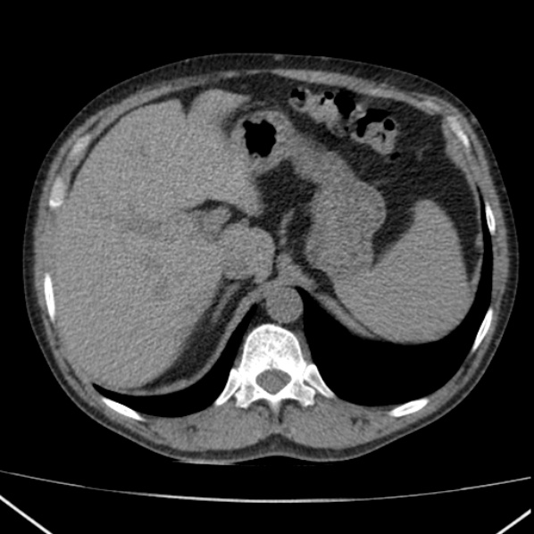 File:Autosomal dominant polycystic kidney disease (Radiopaedia 36539-38101 Axial non-contrast 19).jpg