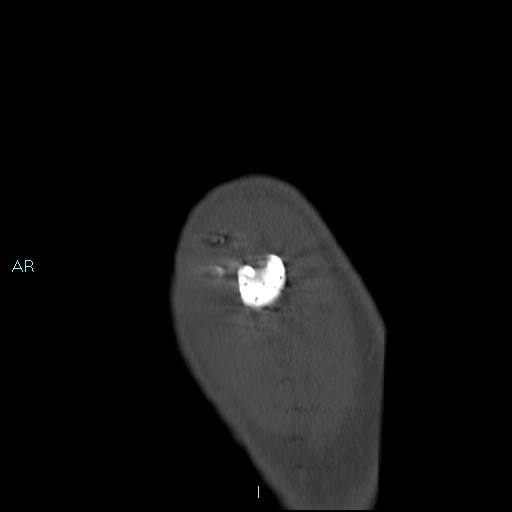 File:Avascular necrosis after fracture dislocations of the proximal humerus (Radiopaedia 88078-104653 Sagittal bone window 10).jpg