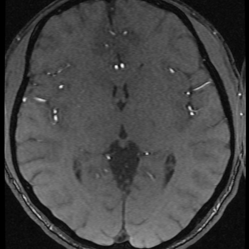 Azygos anterior cerebral artery (Radiopaedia 17059-16756 Axial MRA 17).jpg