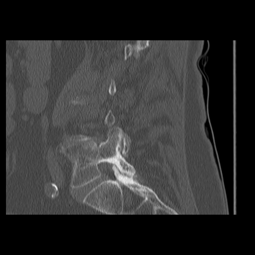 File:Baastrup syndrome with interspinous osteoarthritis (Radiopaedia 18560).jpg