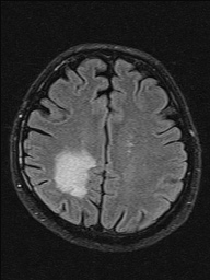 File:Balo concentric sclerosis (Radiopaedia 50458-55940 Axial FLAIR 14).jpg