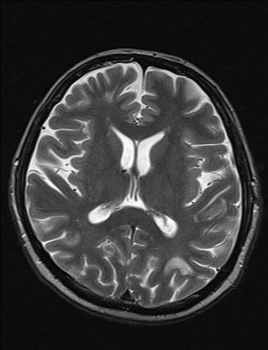 File:Balo concentric sclerosis (Radiopaedia 50458-55940 Axial T2 20).jpg