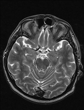 File:Balo concentric sclerosis (Radiopaedia 50458-55940 Axial T2 29).jpg