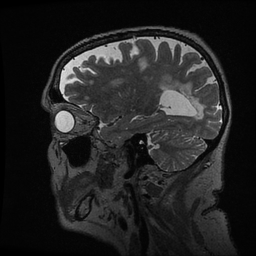 Balo concentric sclerosis (Radiopaedia 53875-59982 Sagittal 3D FSE 90).jpg