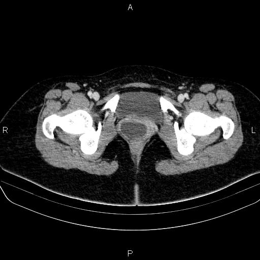 File:Bartholin gland cyst (Radiopaedia 62635-70930 Axial Post contrast 75).jpg