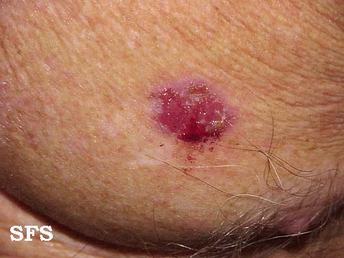 Basal Cell Carcinoma (Dermatology Atlas 6).jpg