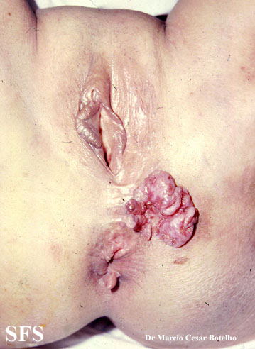 Basal Cell Carcinoma (Dermatology Atlas 74).jpg