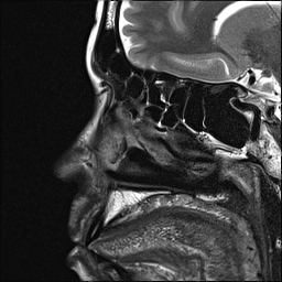File:Basal cell carcinoma - nasal region (Radiopaedia 70292-80365 Sagittal T2 5).jpg