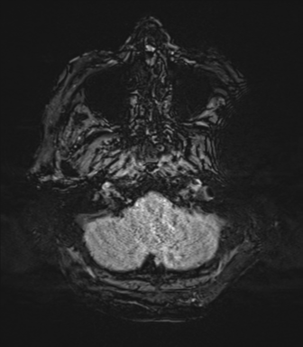 Basal ganglia metastasis (Radiopaedia 78928-91828 Axial SWI 8).png