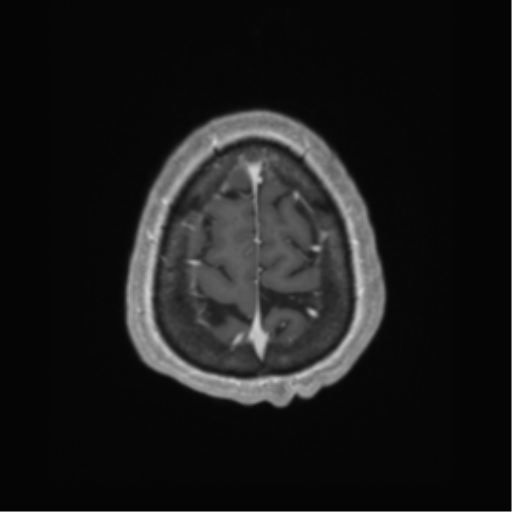 Basal ganglia metastasis (Radiopaedia 78928-91828 Axial T1 C+ 68).png