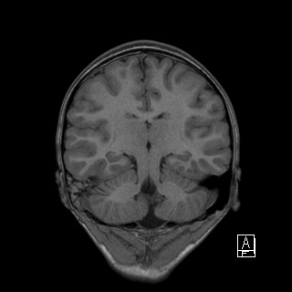 Base of skull rhabdomyosarcoma (Radiopaedia 32196-33142 Coronal T1 30).jpg