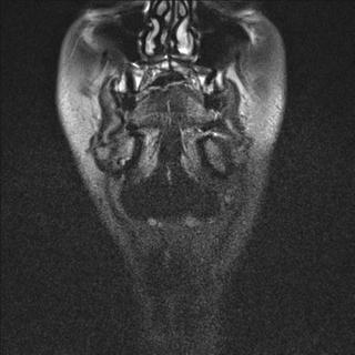 File:Base of tongue squamous cell carcinoma (Radiopaedia 31174-31884 Coronal T2 fat sat 22).jpg