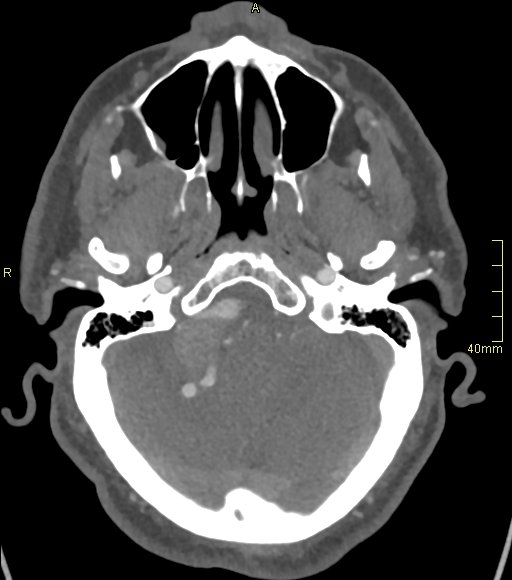 File:Basilar artery aneurysm (Radiopaedia 56261-62932 A 48).jpg