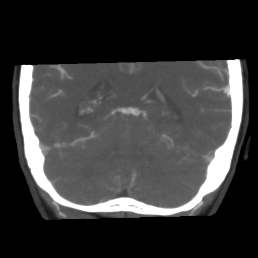 File:Basilar artery fenestration and aneurysms with subarachnoid hemorrhage (Radiopaedia 40066-42573 B 40).png