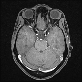 Basilar artery perforator aneurysm (Radiopaedia 82455-97733 Axial T1 fat sat 54).jpg
